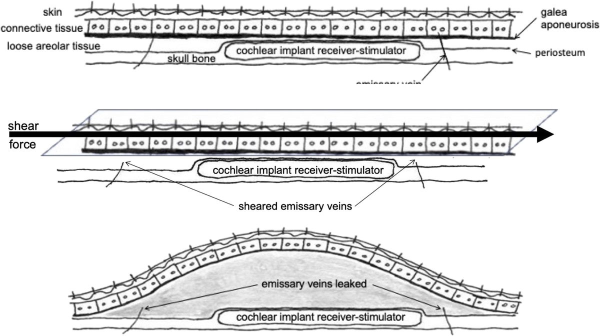 COMPLIMENTS TO SHAIDA ET AL. IN DESCRIBING SWELLING OVER COCHLEAR IMPLANT RECEIVER-STIMULATOR PACKAGE: MOREL-LAVALLÉE IS LIKELY AN ETIOLOGIC MECHANISM