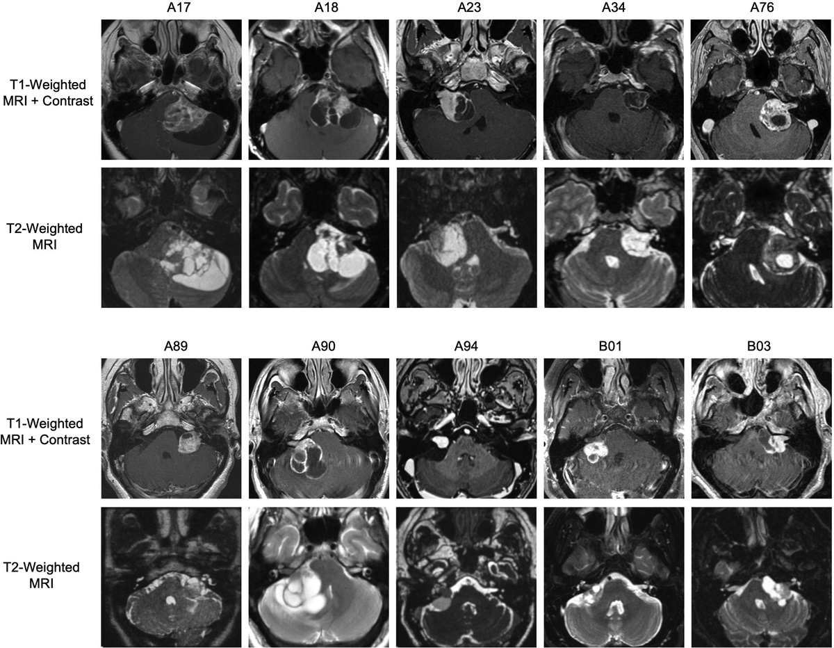 Cytokine Profiling of Cyst Fluid and Tumor-Associated Macrophages in Cystic Vestibular Schwannoma