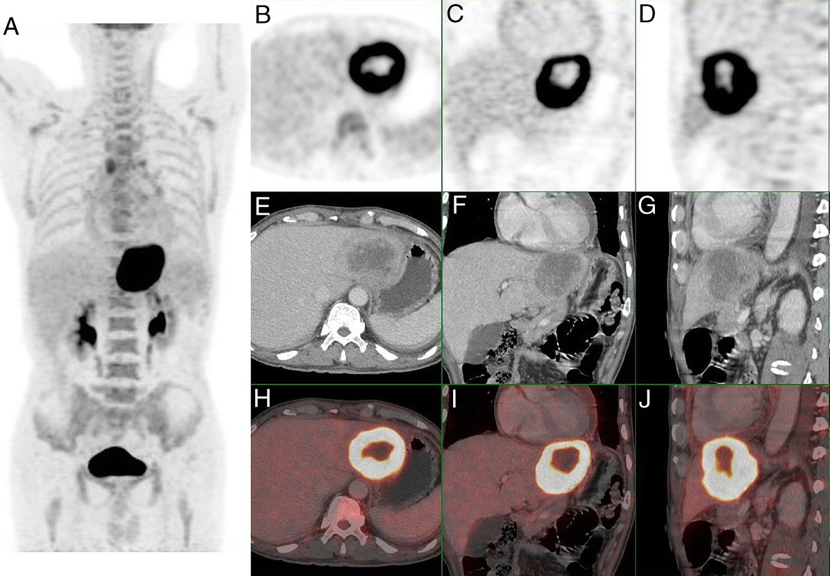 Unusual Case of Primary Hepatic Squamous Carcinoma on 18F-FDG PET/CT