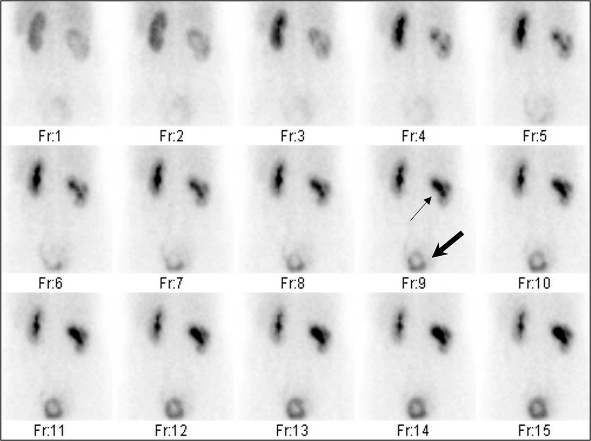 Large Bladder Stone Detected on Renal Scintigraphy