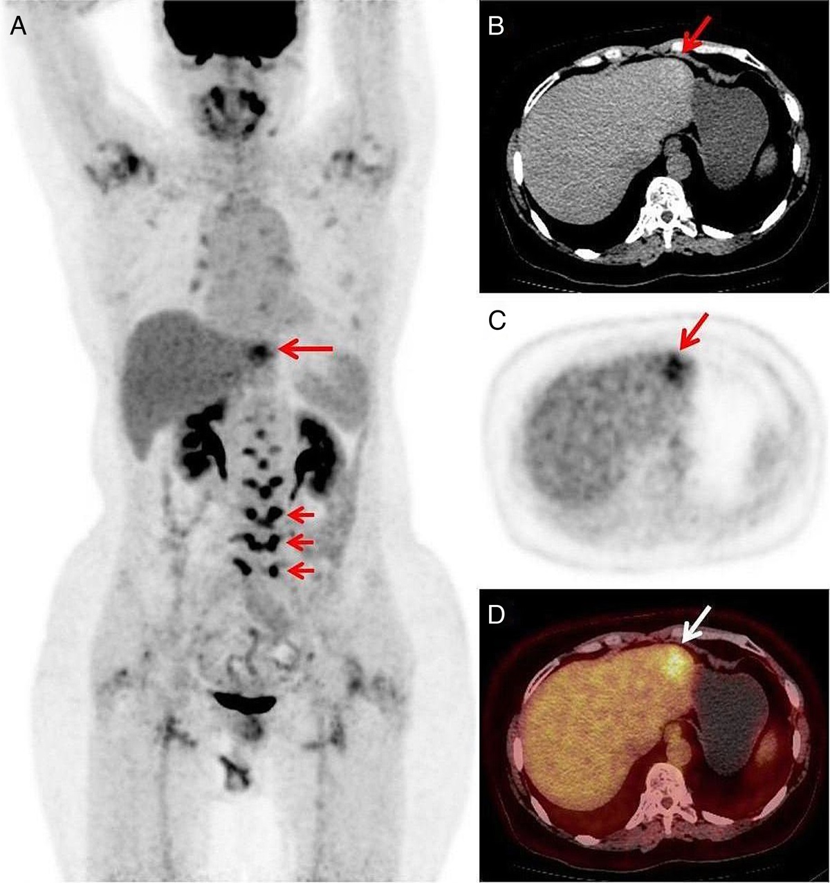 Hepatic Cavernous Hemangioma Mimicking Malignancy on 18F-FDG PET/CT Imaging
