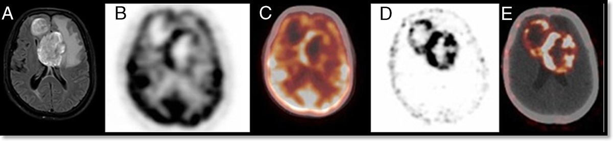 68Ga-PSMA-11 PET/CT Imaging in Brain Gliomas and Its Correlation With Clinicopathological Prognostic Parameters