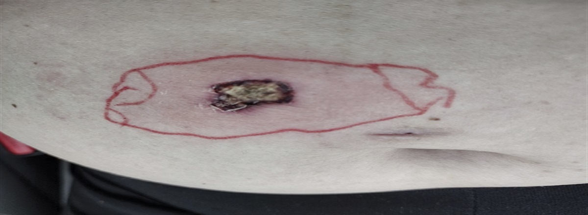 Postpartum Extended-Release Buprenorphine Tissue Necrosis