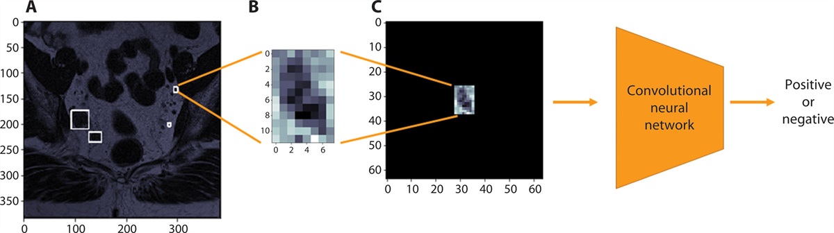 Development of a Diagnostic Artificial Intelligence Tool for Lateral Lymph Node Metastasis in Advanced Rectal Cancer