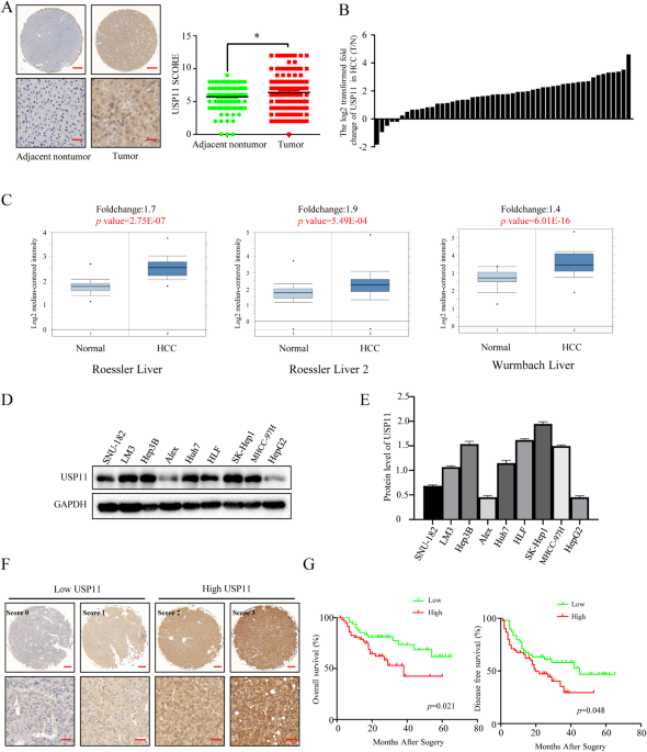 USP11 potentiates HGF/AKT signaling and drives metastasis in hepatocellular carcinoma