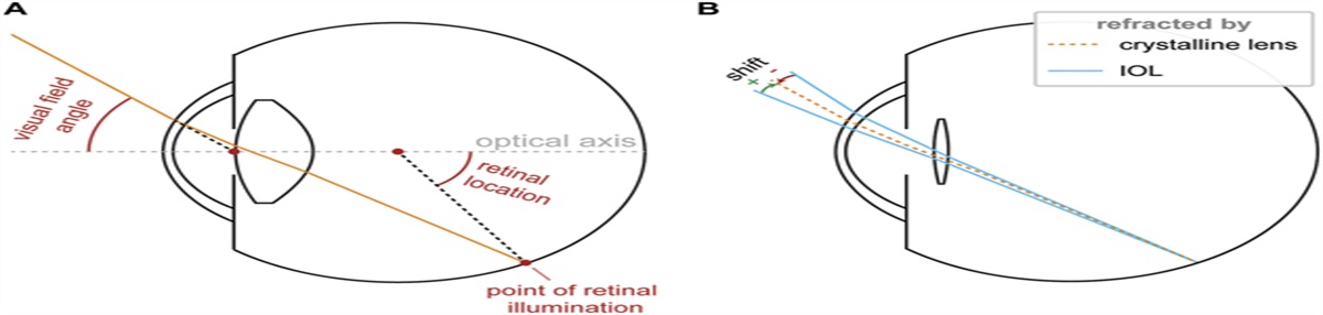 Peripheral visual field shifts after intraocular lens implantation