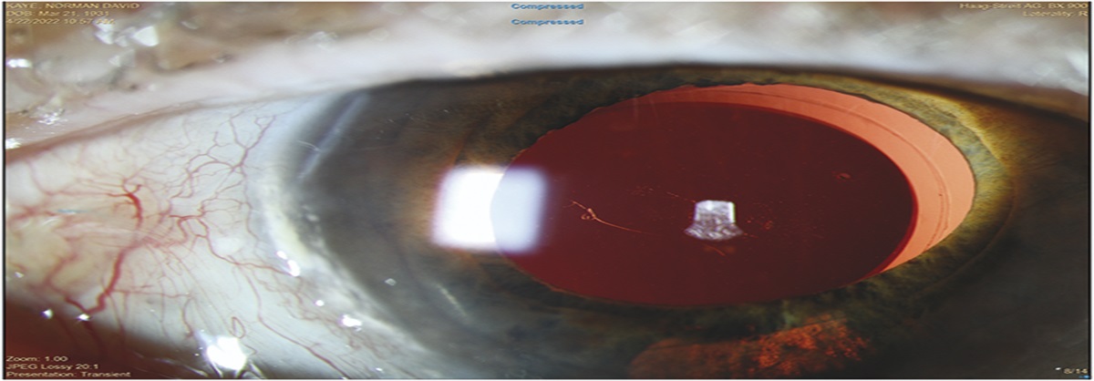 SCLERAL SUTURE FIXATION FOR DISLOCATED SILICONE PLATE HAPTIC INTRAOCULAR LENS