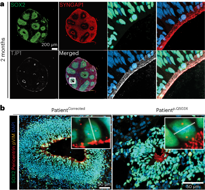 Discovery of a non-canonical function of SYNGAP1 at early stages of human cortical neurogenesis