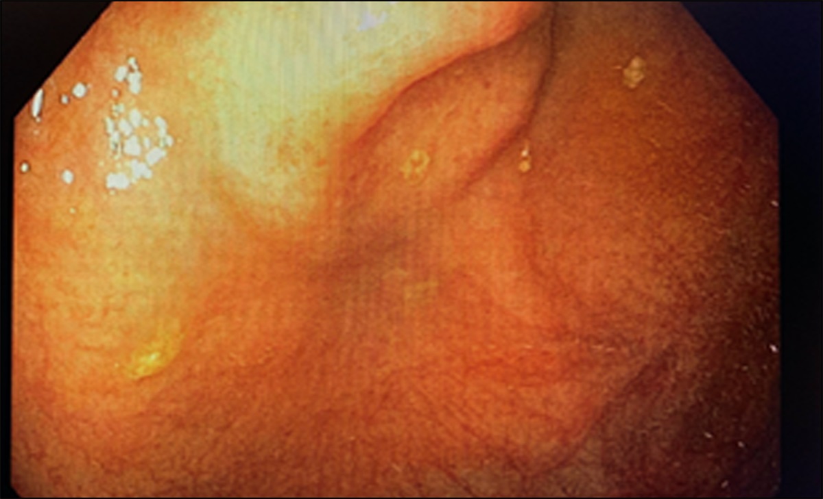 Taking Caution at Road's End: Incidental Finding of Appendiceal Goblet Cell Tumor on Colonoscopy