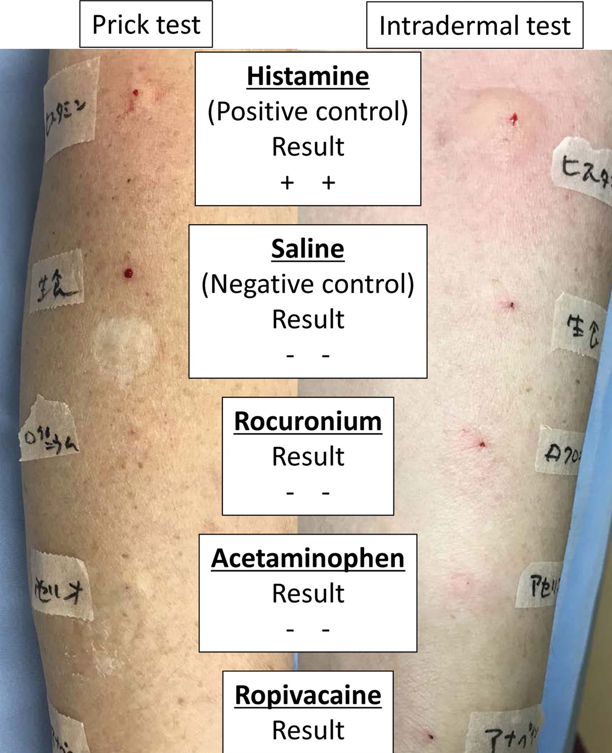 Delayed Nonimmune Anaphylaxis Caused by Ropivacaine for Preoperative Nerve Blocks: A Case Report
