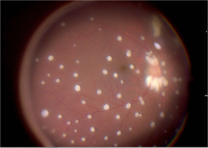 Misdiagnosed case of fungal endophthalmitis