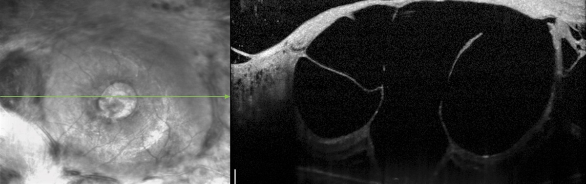 Minimal, Relaxing Membranectomies for the Management of Opacified Hyaloid With Diabetic Tractional Retinal Detachments in Monocular Patients: A Novel Surgical Technique